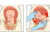 【健康】宝宝“调皮”坐在子宫里，医生来帮忙“华丽转身”