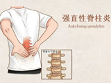 【健康】大爷患病脊柱“石化”，不慎摔倒颈椎当场骨折
